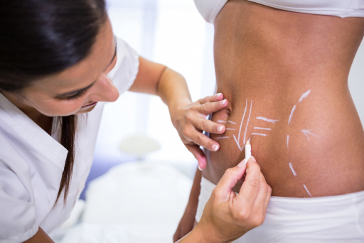 Liposuction at Qasawa Plastic Surgery in Troy, Michigan